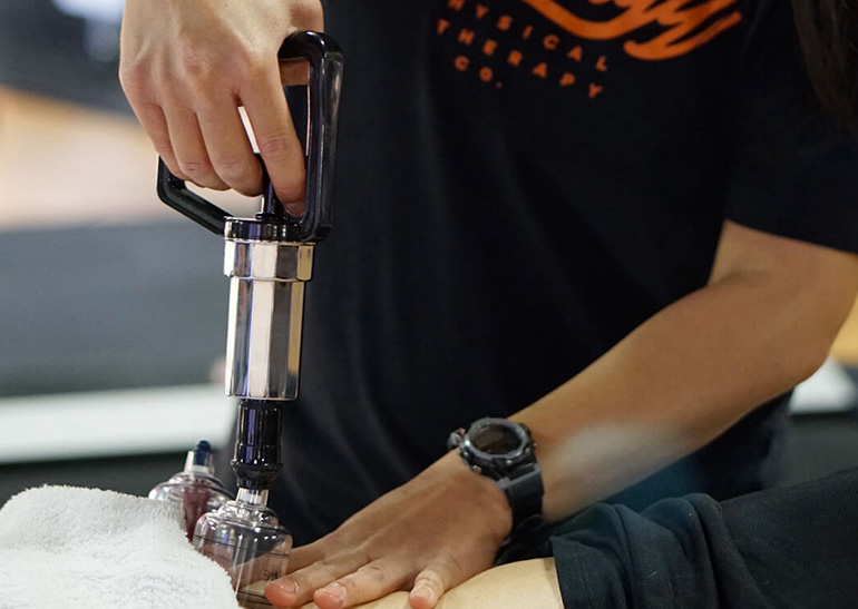 Therapist administering cupping therapy at Synergy Physical Therapy in Scottsdale, AZ